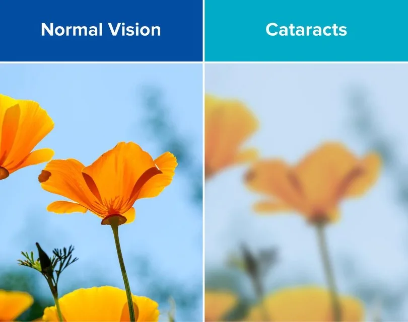 Side-by-side comparison of normal vision versus blurred vision caused by cataracts