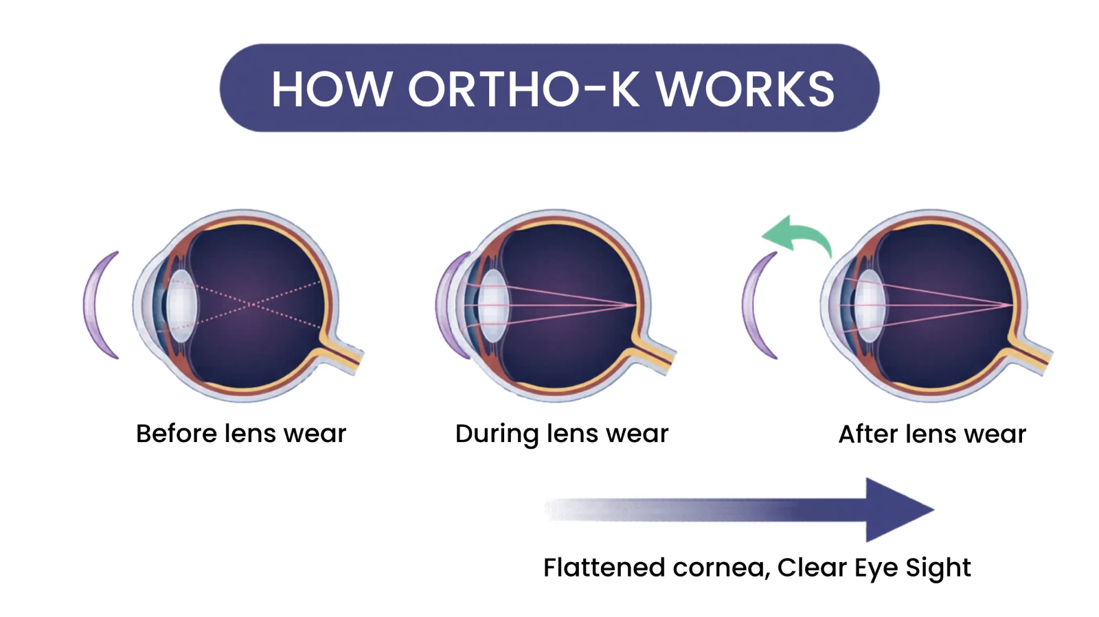How Ortho-K works diagram showing the eye before lens wear with a steep cornea, during overnight lens wear, and after lens wear with a flattened cornea for clear eyesight.