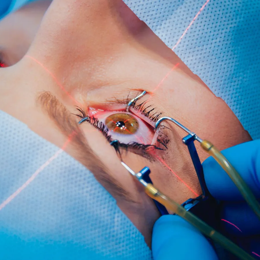 LASIK laser eye surgery being performed on a patient's eye at Cure For Eyes, Gurugram
