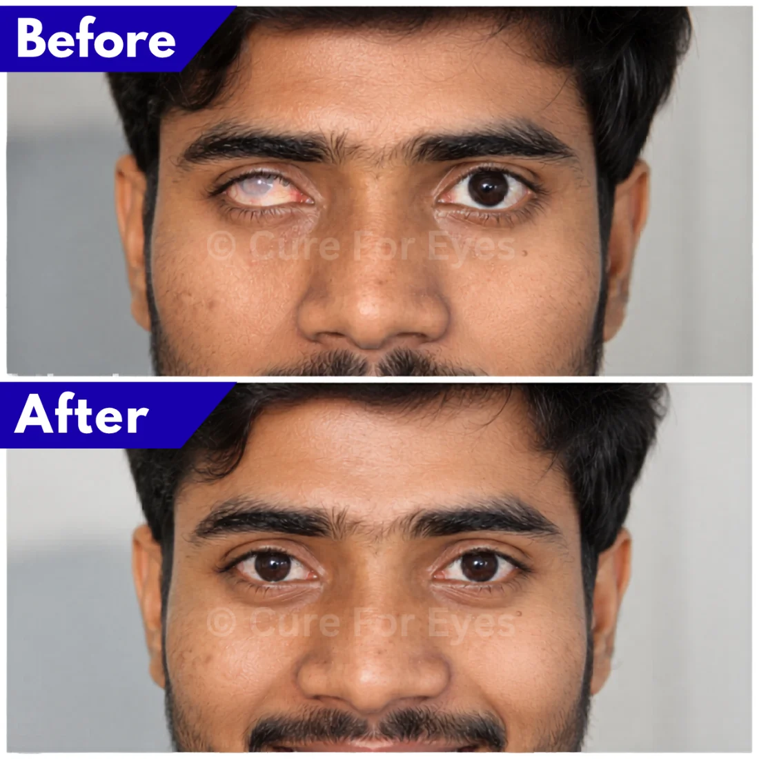 Before and after photo of a male patient fitted with a custom hand-painted artificial eye (ocular prosthesis) at Cure For Eyes Gurugram — the disfigured white eye is restored to a natural, colour-matched brown eye with full facial symmetry.
